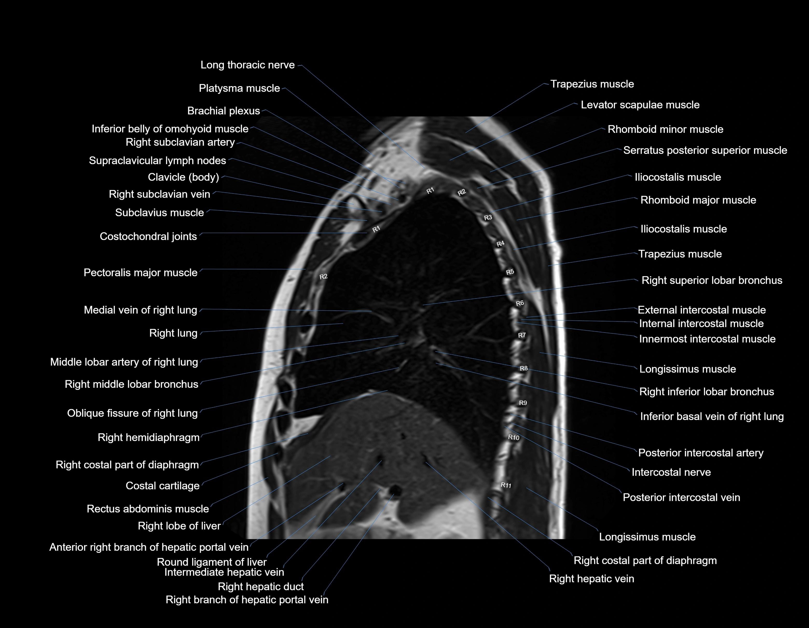 MRI chest (thorax) sagittal labelled cross sectional anatomy 3T radiology image-img-00001-00014.webp